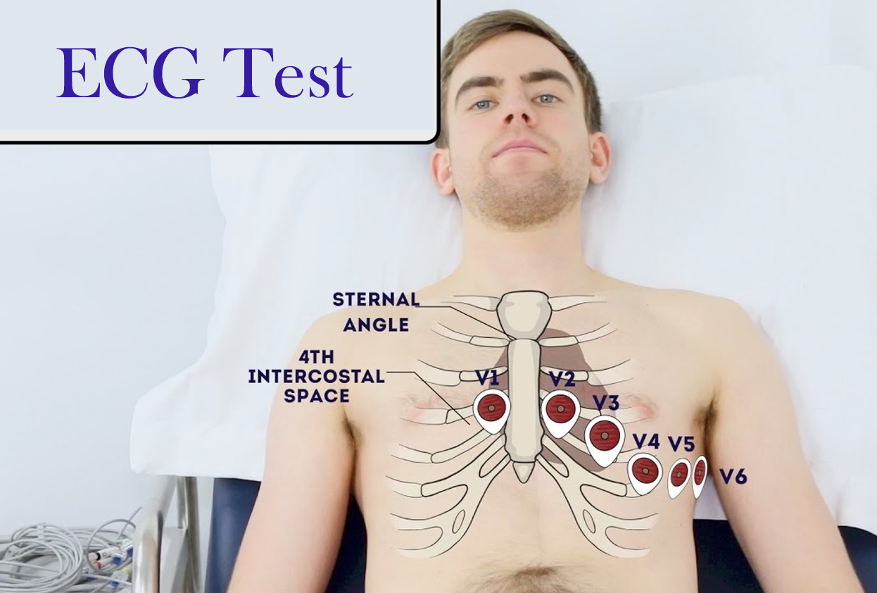 ECG