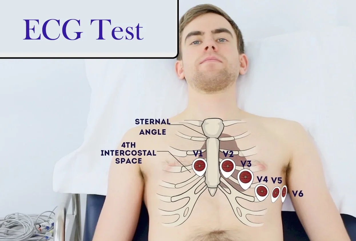 ECG